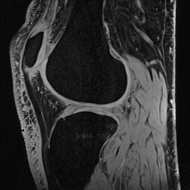 Anterior cruciate ligament tear - ramp lesion (Radiopaedia 71883-82322 Sagittal T1 vibe 51).jpg