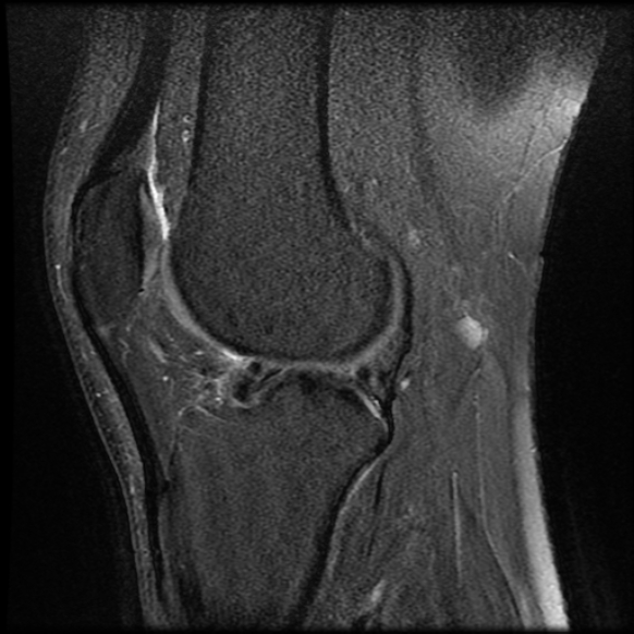 File:Anterior cruciate ligament tear with posteromedial corner injury, bucket-handle meniscal tear and chondral delamination (Radiopaedia 75501-86744 Sagittal PD fat sat 17).jpg