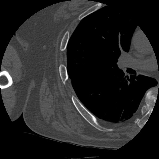 Anterior glenohumeral dislocation with Hill-Sachs lesion (Radiopaedia 62877-71249 Axial bone window 96).jpg