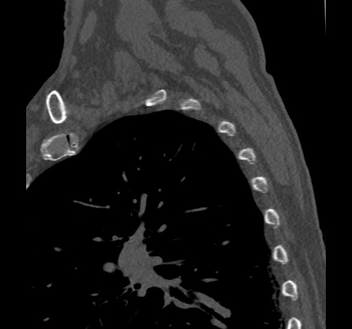 File:Anterior glenohumeral dislocation with Hill-Sachs lesion (Radiopaedia 62877-71249 Sagittal bone window 66).jpg