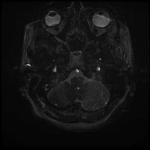Anterior inferior cerebellar artery vascular loop - type II (Radiopaedia 70991-81209 Axial 3D FIESTA 75).jpg