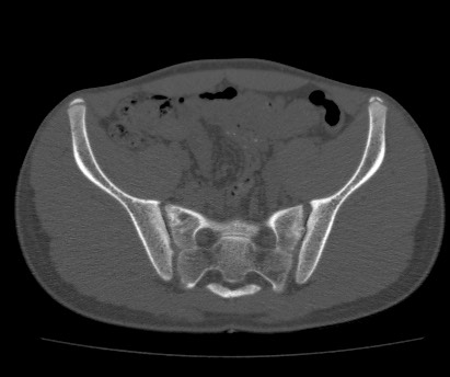 Anterior inferior iliac spine avulsion fracture (Radiopaedia 81312-94999 Axial bone window 32).jpg