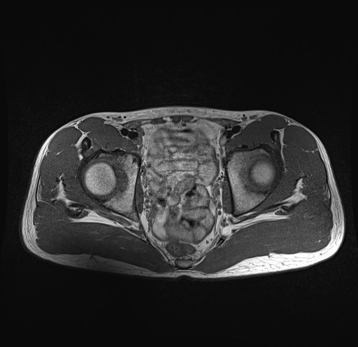 File:Anterior inferior iliac spine avulsion fracture (Radiopaedia 81312-95000 Axial T1 19).jpg