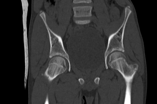 Anterior inferior iliac spine avulsion injury (Radiopaedia 88666-105376 Coronal bone window 34).jpg
