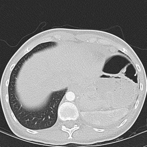 Anterior mediastinal lymphoma (Radiopaedia 29556-30061 Axial lung window 48).jpg