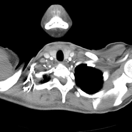 File:Anterior mediastinal lymphoma (Radiopaedia 29556-30061 C 5).jpg
