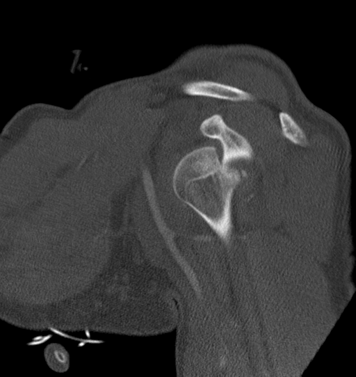 Anterior shoulder dislocation with Hill-Sachs and bony Bankart lesions (Radiopaedia 40424-42974 Sagittal bone window 25).png