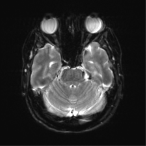 File:Anterior temporal lobe perivascular space (Radiopaedia 40946-43650 Axial DWI 8).png