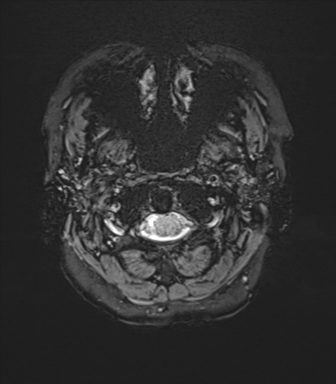 Anterior temporal lobe perivascular space (Radiopaedia 40946-43650 Axial SWI 1).png