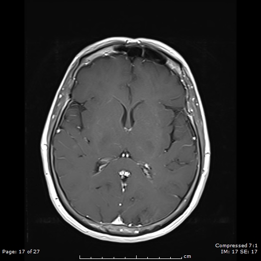 File:Anterior temporal lobe perivascular space (Radiopaedia 88283-104914 Axial T1 C+ 17).jpg