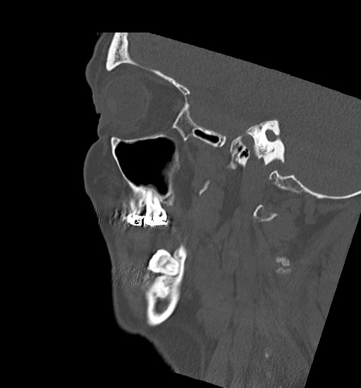 Anterior temporomandibular joint dislocation (Radiopaedia 59430-66784 B 46).jpg