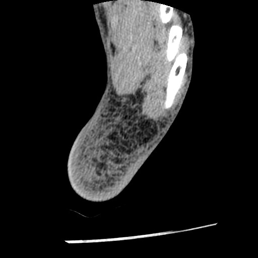 Anterior tibial artery false aneurysm (Radiopaedia 88984-105809 A 246).jpg