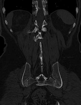 File:Anterior vertebral scalloping (abdominal aortic aneurysm) (Radiopaedia 66744-76067 Coronal bone window 59).jpg