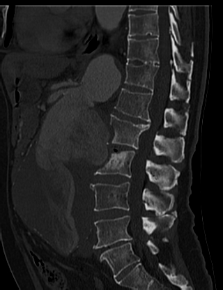 File:Anterior vertebral scalloping (abdominal aortic aneurysm) (Radiopaedia 66744-76067 Sagittal bone window 37).jpg
