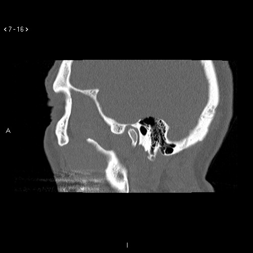 File:Antrochoanal Polyp (Radiopaedia 70510-80631 Sagittal bone window 6).jpg