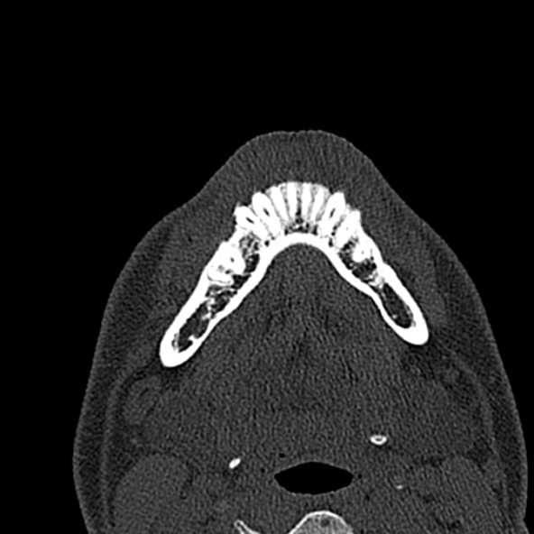 Antrochoanal polyp (Radiopaedia 30002-30554 Axial bone window 1).jpg