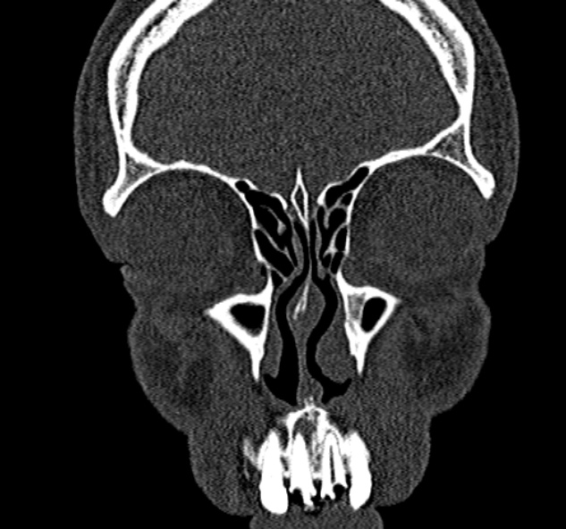 Antrochoanal polyp (Radiopaedia 30002-30554 Coronal bone window 22).jpg