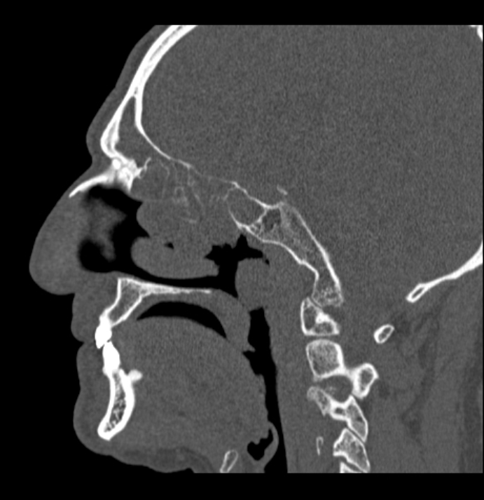Antrochoanal polyp (Radiopaedia 79011-92169 Sagittal bone window 39).jpg