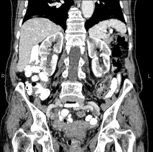File:Aortic aneurysm and Lemmel syndrome (Radiopaedia 86499-102554 C 41).jpg