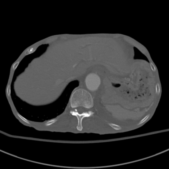 File:Aortic aneurysm with spinal destruction (Radiopaedia 42301-45410 Axial bone window 15).jpg