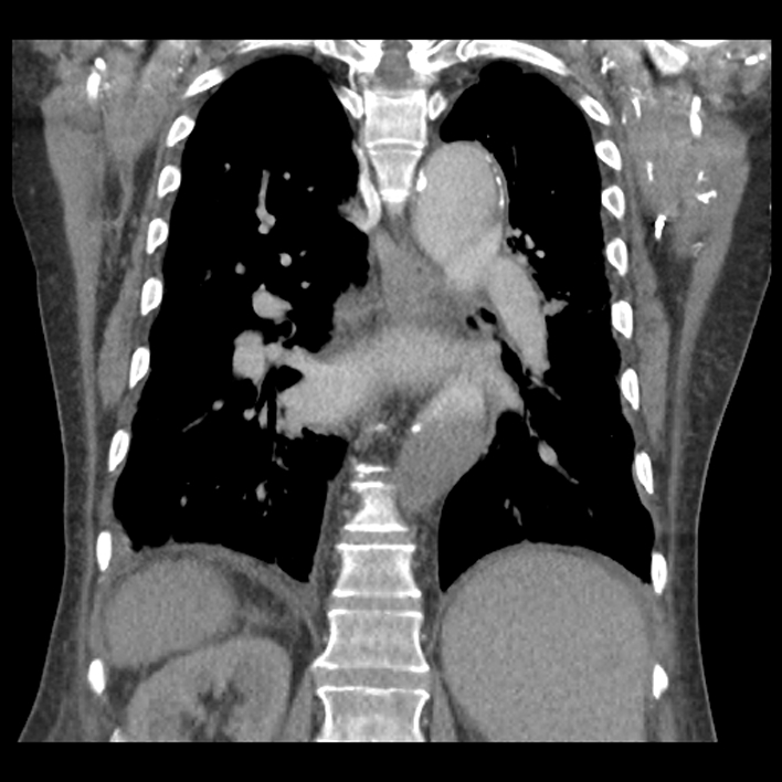 Aortic arch graft infection (FDG PET-CT) (Radiopaedia 71975-82437 Coronal 42).jpg