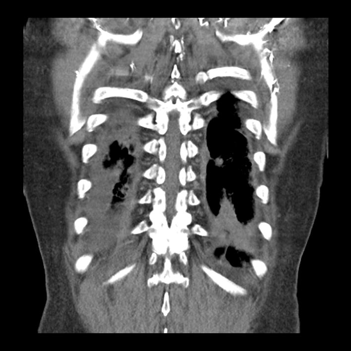 Aortic arch graft infection (FDG PET-CT) (Radiopaedia 71975-82437 Coronal 52).jpg