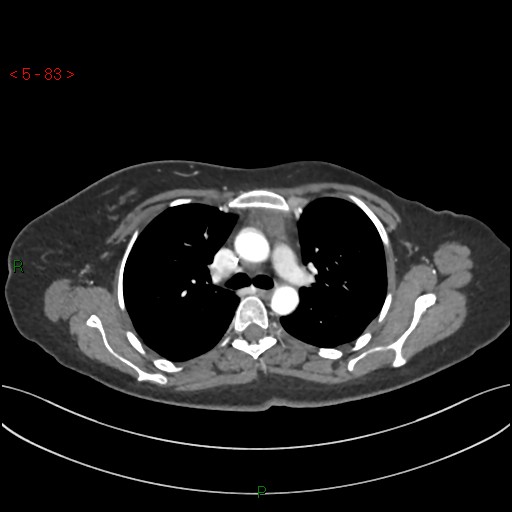 File:Aortic arch origin of left vertebral artery (Radiopaedia 51520-57286 A 82).jpg