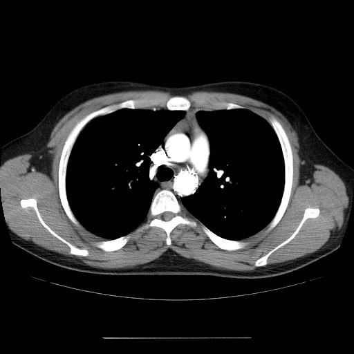 File:Aortic arch stent (Radiopaedia 30030-30595 D 12).jpg