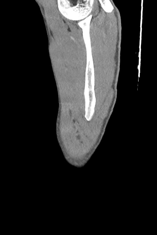 Aortic coarctation with aneurysm (Radiopaedia 74818-85828 B 7).jpg