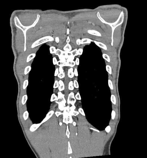 Aortic coarctation with aneurysm (Radiopaedia 74818-85828 C 103).jpg