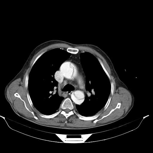 Aortic dissection- Stanford type A (Radiopaedia 22085-22085 A 18).jpg