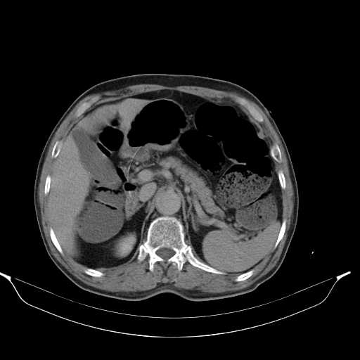 Aortic dissection- Stanford type A (Radiopaedia 22085-22085 Axial C+ delayed 15).jpg