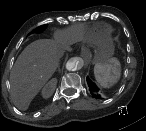 Aortic dissection (CTPA) (Radiopaedia 75506-86750 A 79).jpg