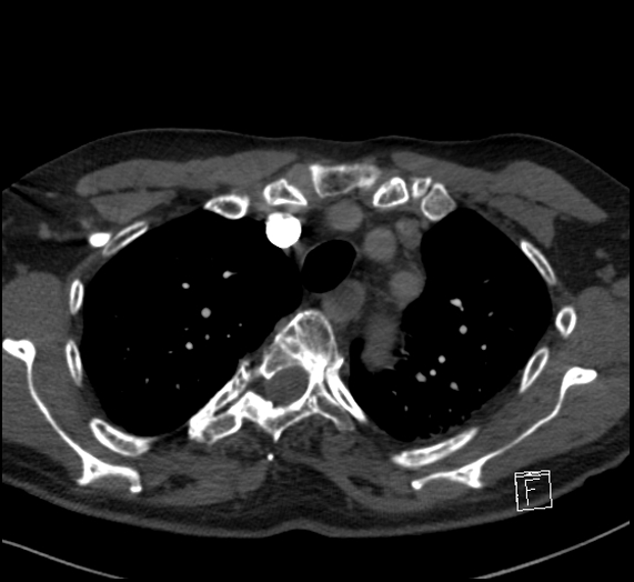 File:Aortic dissection (CTPA) (Radiopaedia 75506-86751 Axial C+ CTPA 31).jpg
