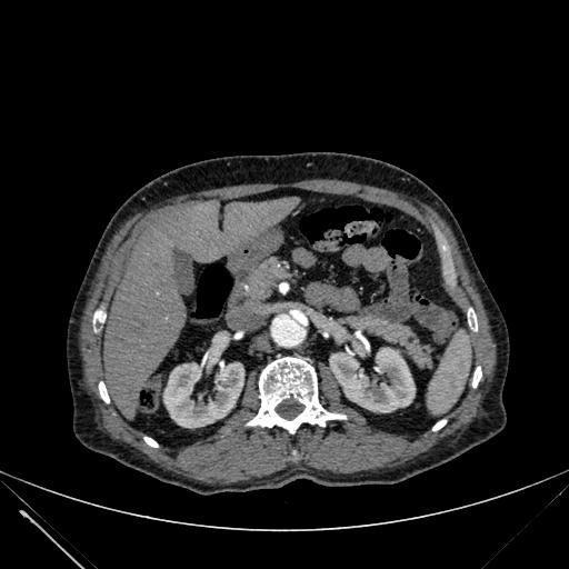 Aortic dissection (Radiopaedia 27466-27665 C+ arterial phase 331).jpg