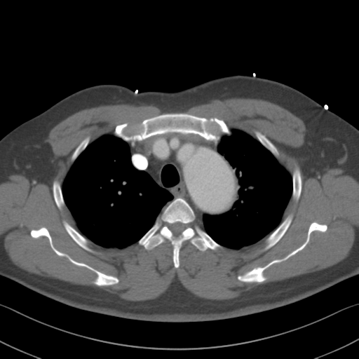 Aortic dissection (Radiopaedia 50763-56234 A 8).png