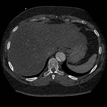 File:Aortic dissection (Radiopaedia 57969-64959 A 267).jpg