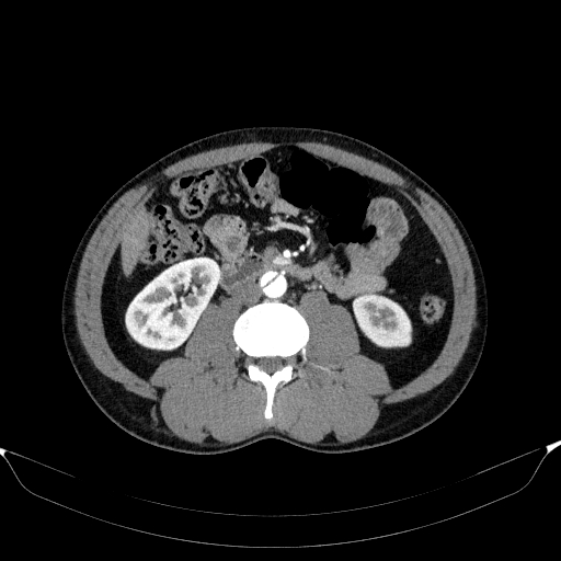 Aortic dissection - Stanford type A (Radiopaedia 83418-98500 A 81).jpg