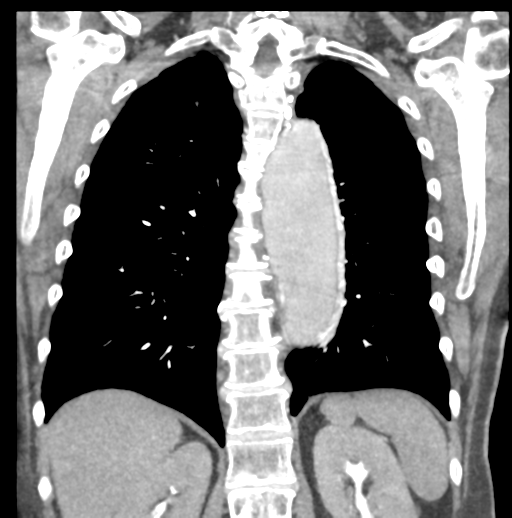 File:Aortic dissection - Stanford type B (Radiopaedia 50171-55512 B 61).png