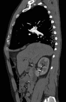 File:Aortic dissection - Stanford type B (Radiopaedia 73648-84437 C 104).jpg