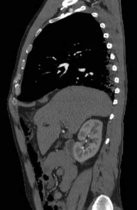 File:Aortic dissection - Stanford type B (Radiopaedia 73648-84437 C 108).jpg