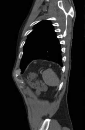 File:Aortic dissection - Stanford type B (Radiopaedia 73648-84437 C 17).jpg