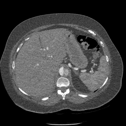 Aortic dissection - Stanford type B (Radiopaedia 88281-104910 A 95).jpg