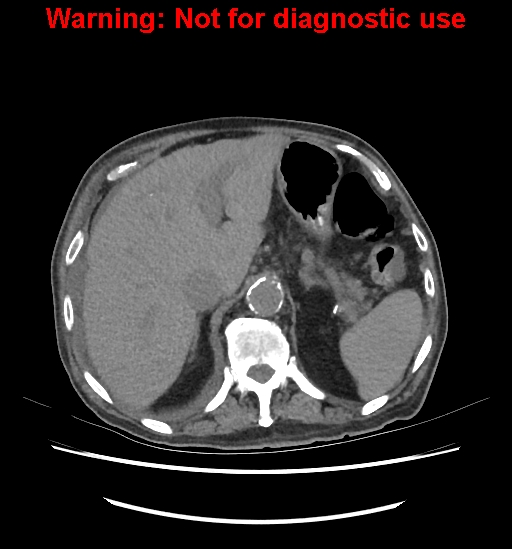 Aortic graft infection (Radiopaedia 44979-48907 Axial non-contrast 29).jpg