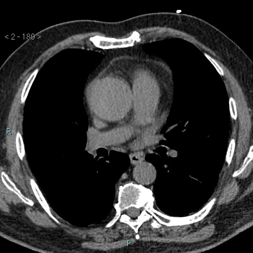 Aortic intramural hematoma (Radiopaedia 48463-53380 Axial non-contrast 80).jpg