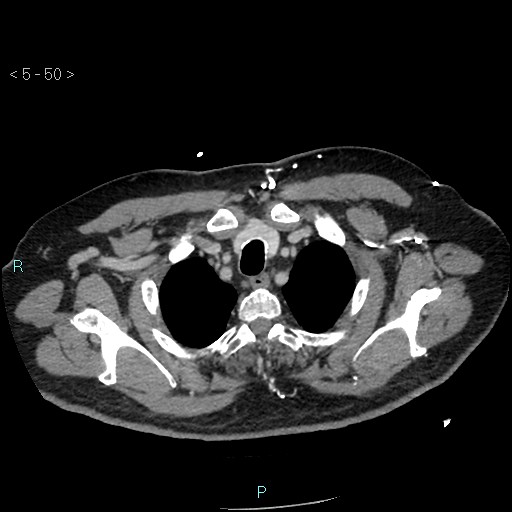 Aortic intramural hematoma (Radiopaedia 48463-53380 C 24).jpg