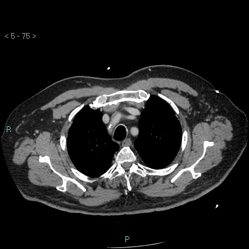 Aortic intramural hematoma (Radiopaedia 48463-53380 C 35).jpg