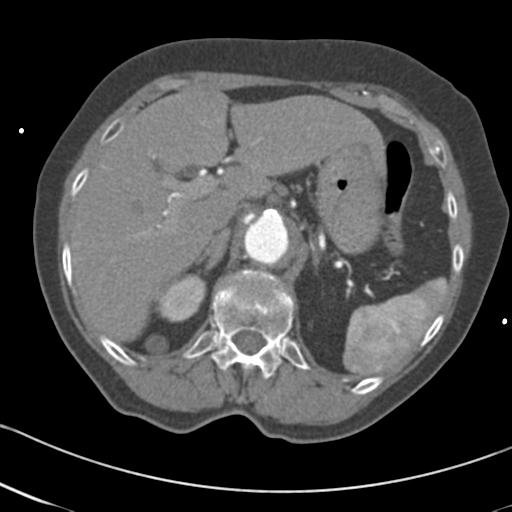 Aortic intramural hematoma from penetrating atherosclerotic ulcer (Radiopaedia 31137-31836 A 81).jpg