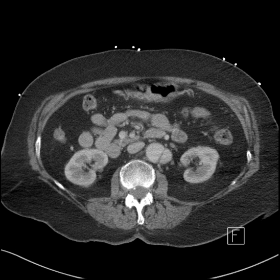 File:Aortic intramural hematoma with dissection and intramural blood pool (Radiopaedia 77373-89491 E 32).jpg