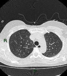 File:Aortic valve endocarditis (Radiopaedia 87209-103485 Axial lung window 30).jpg